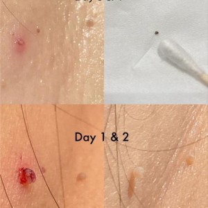 新手脱疣篇 • 上集